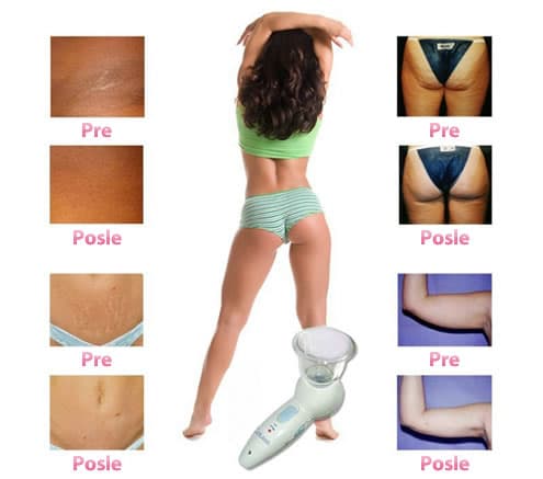 Celluless - Anticelulit masažer za vidno smanjenje celulita